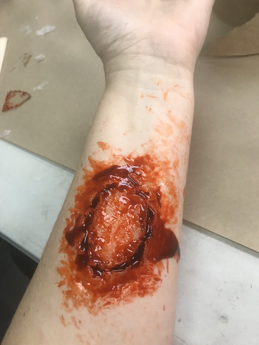 Bite On Arm