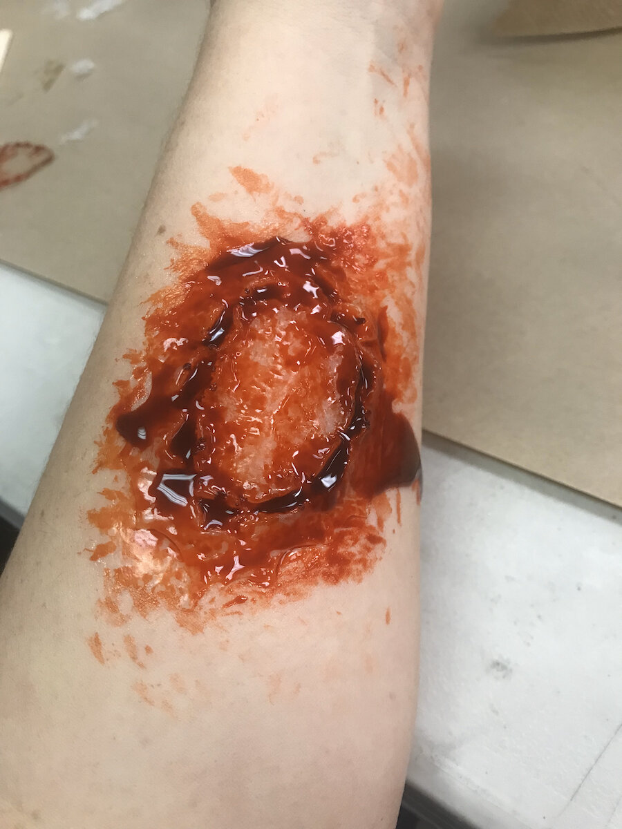 Bite On Arm