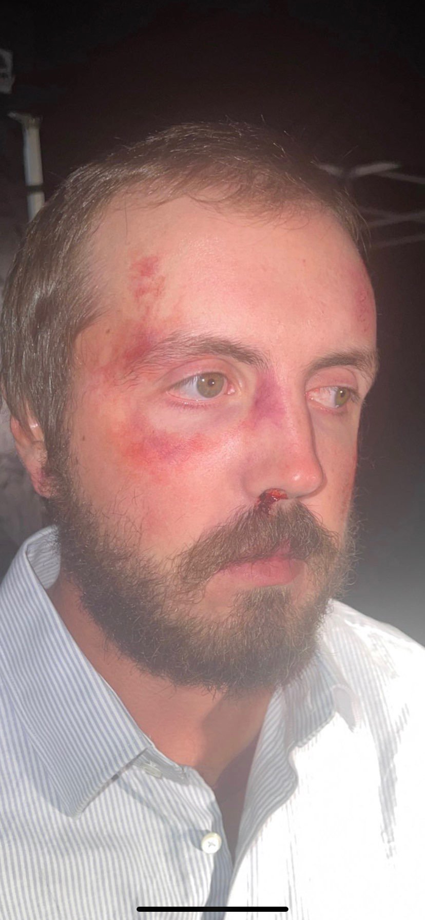 Punched in face (fresh)