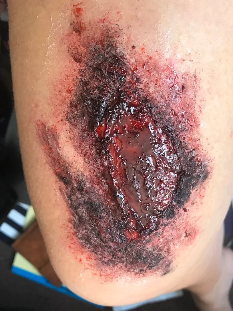 BURN (3RD DEGREE - ON LEG - SEVERE)
