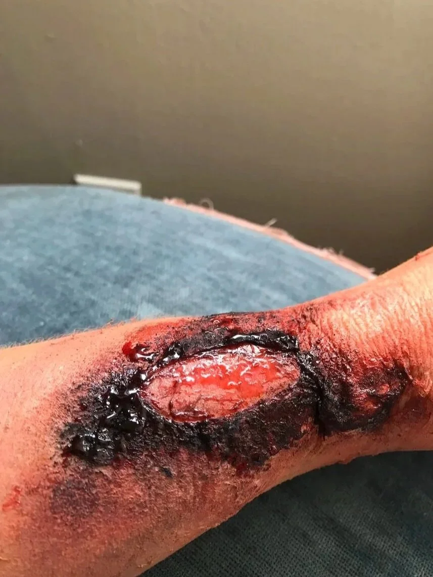 BURN (3RD DEGREE - OPEN FLESH)