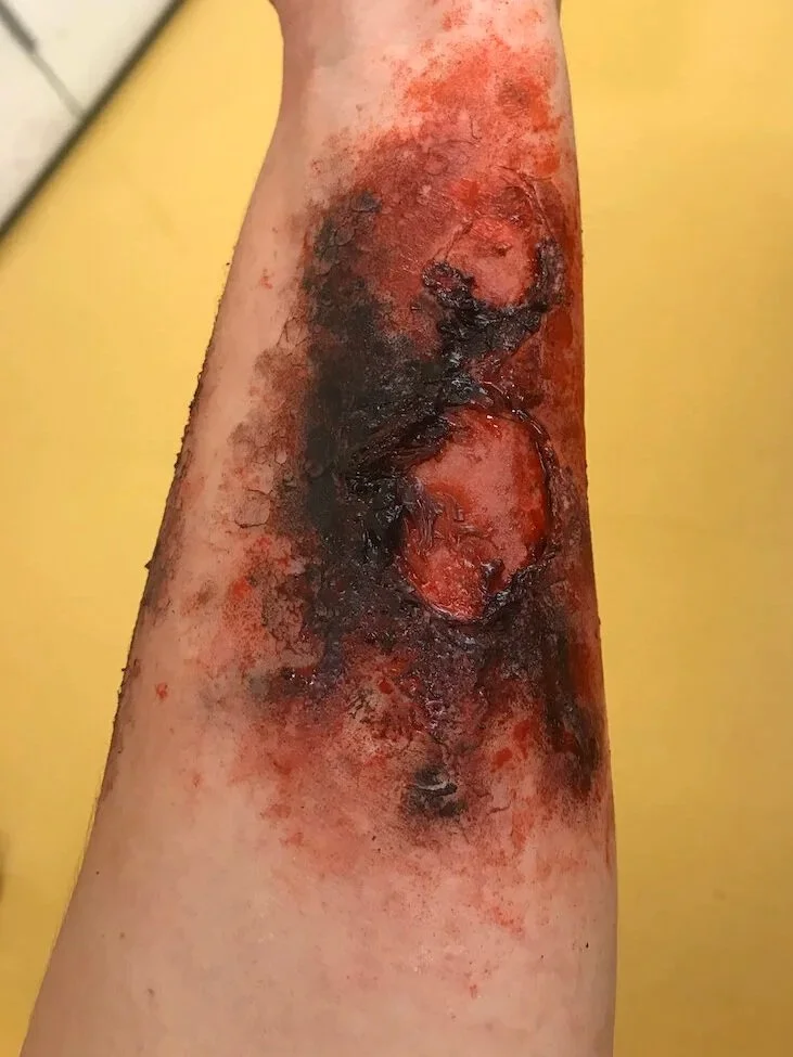 BURN (3RD DEGREE)