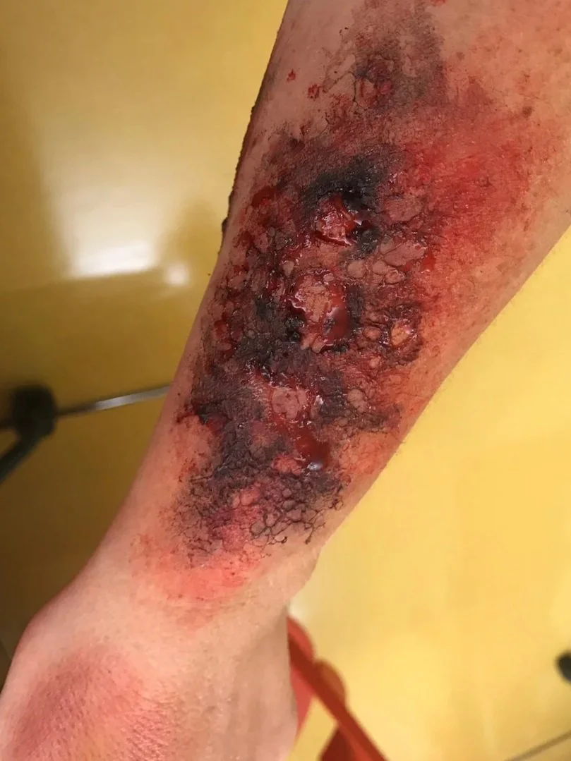 BURN (2ND DEGREE)