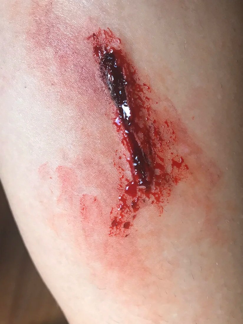 Wound