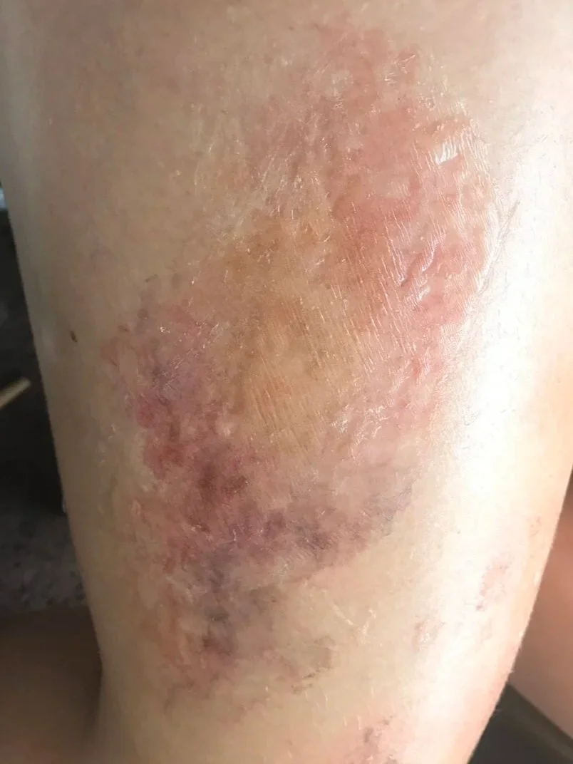 CHEMICAL BURN