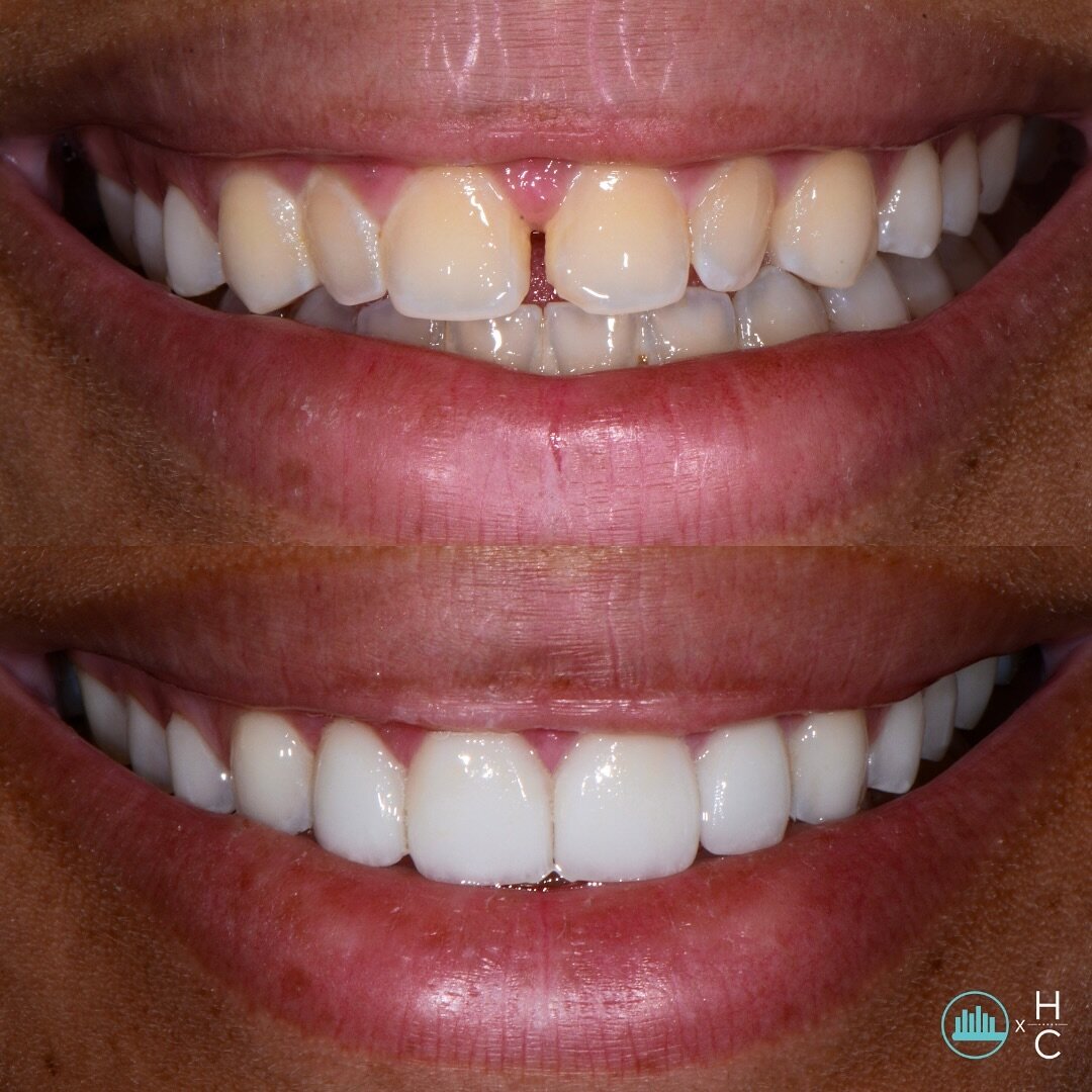 Smile Highlight: Celeste
Celeste came to us wanting to close the gaps in her teeth, which we were able to achieve with an Invisalign treatment. She also expressed interest in wanting a fuller, brighter smile. To achieve this, we did a professional in