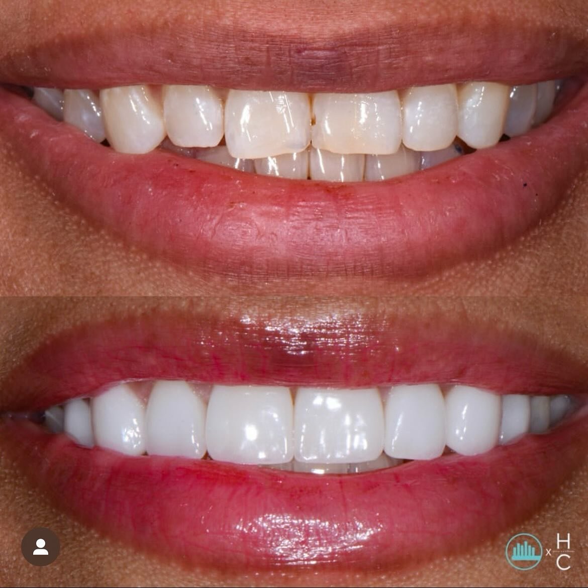 Case Highlight: Natasha 
Natasha had bonding on her front teeth to try to mask a cosmetic issue, but felt that it actually made her teeth look worse. She lived with the bonding for many years before finally deciding it was time for a change. She did 