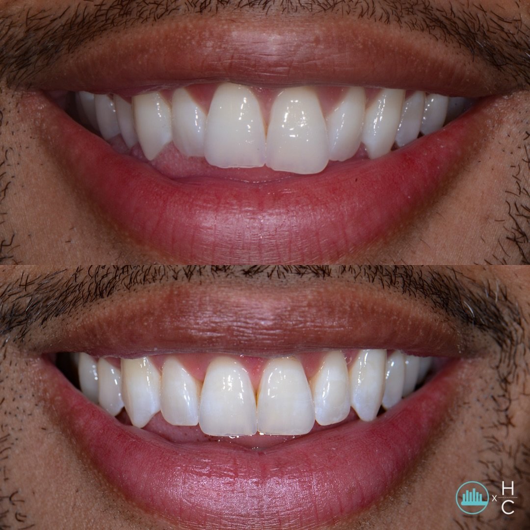 - INVISALIGN ONLY - not only does Invisalign help improve the appearance of your teeth, it also helps to improve the overall health of your mouth as well! This is because properly aligned teeth are easier to keep clean. No crowding or misalignment me