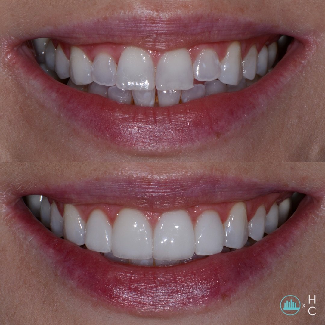 Ieva wanted a smile she could show off with confidence. She came to see Dr. Hoffman after reading a ton of positive reviews online and seeing smile makeovers similar to hers on his social media pages. To give Ieva the results she desired, Dr. Hoffman