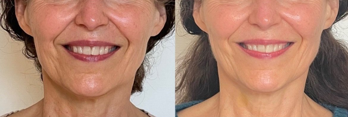 facial acupuncture results for aging skin in Bend Oregon