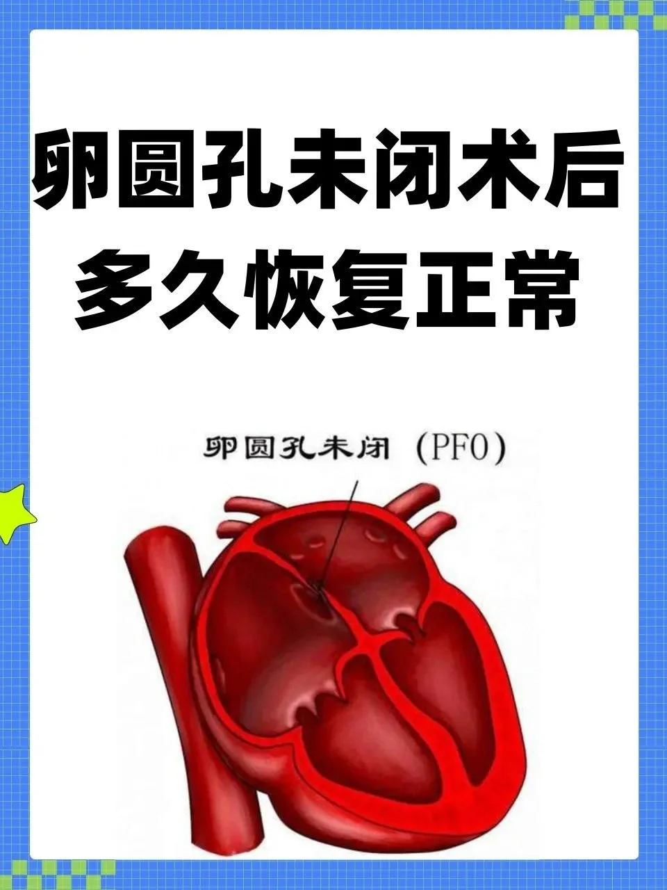 Patent foramen ovale (PFO)