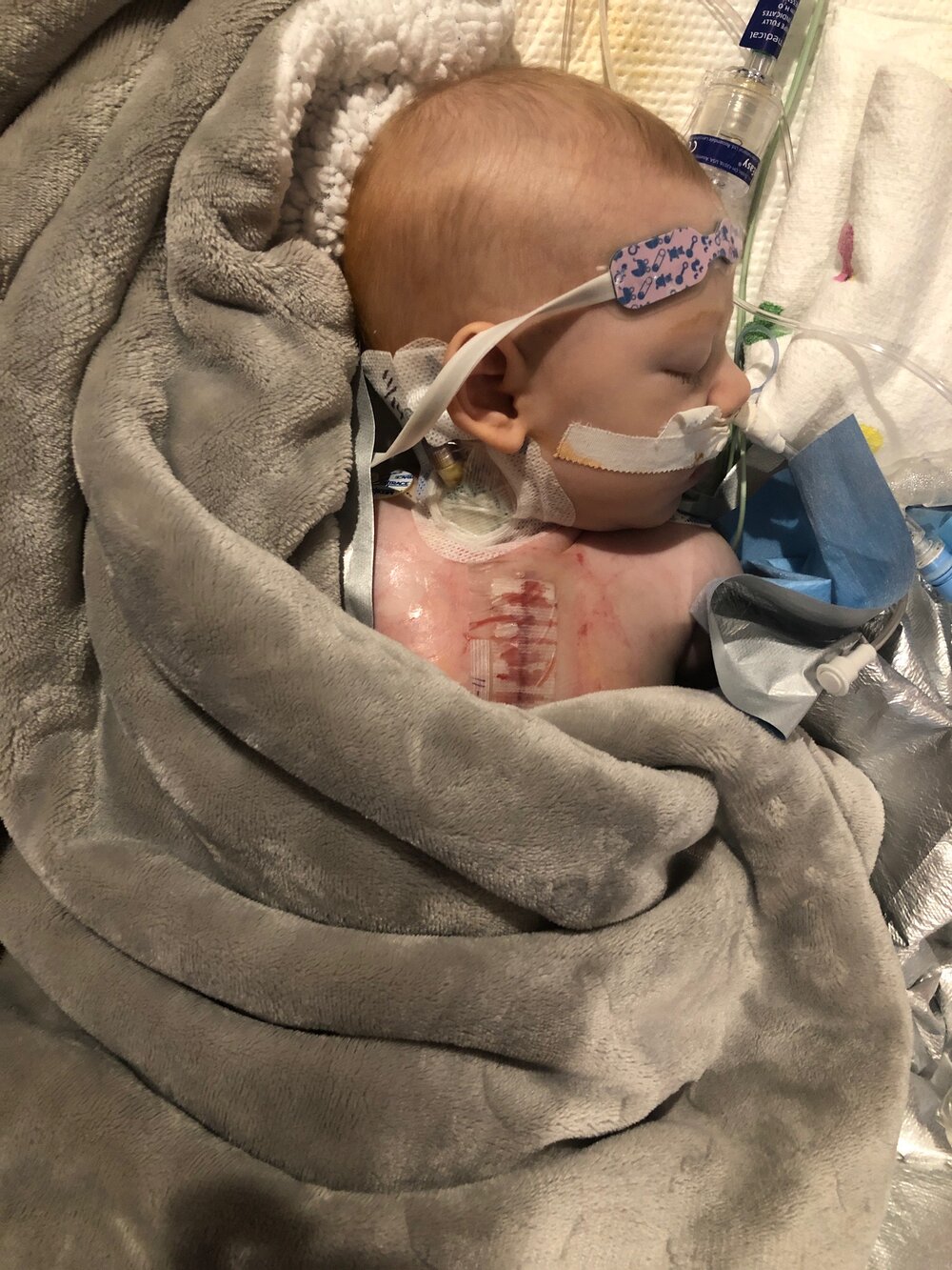 A couple days before Thanksgiving. Noah went in to respiratory failure and needed emergency intubation. This was a few hours after they told us he likely wasn’t going to make it. 