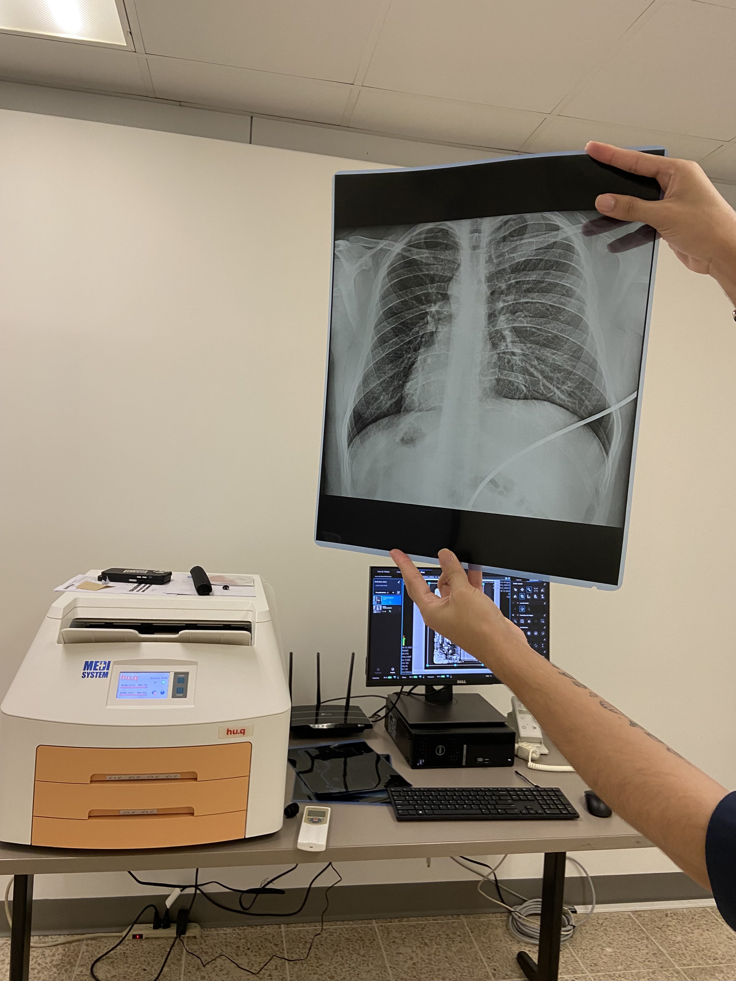 lung xray.jpeg