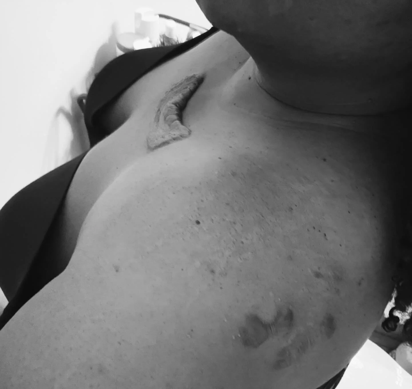 I created Scarred and Free in May of 2019. I remember saying, &ldquo;This platform is for the warriors, not me.&rdquo; I failed to realize I was a part of this community. I carry these markings, too. It took me decades to look at my keloids in the mi
