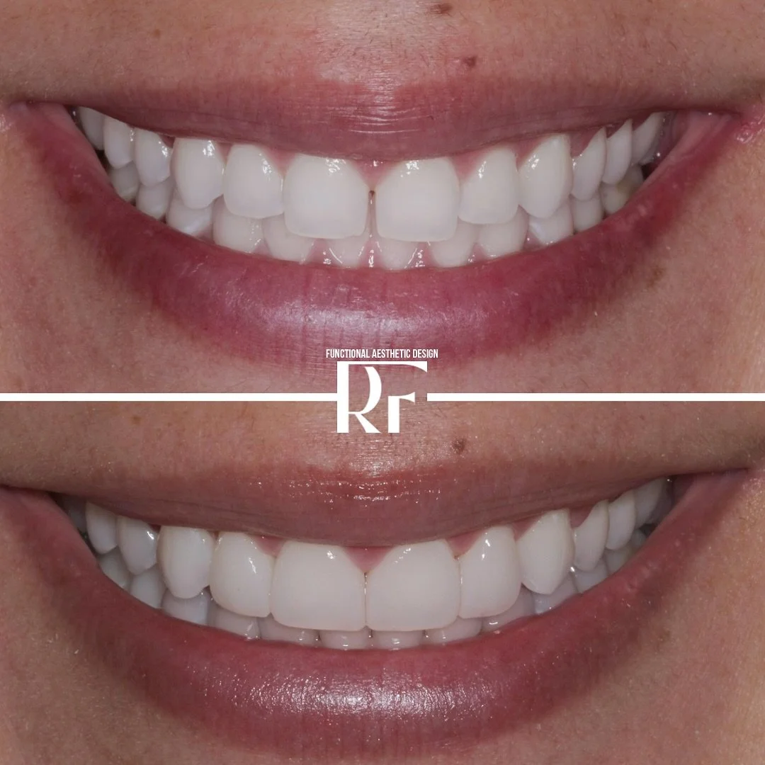 She used to hide her smile in every photo &mdash; now she can&rsquo;t stop smiling. 💎

Just four composite veneers transformed more than her teeth &mdash; they gave her confidence, joy, and a reason to shine again. 

This is more than dentistry. 
Th