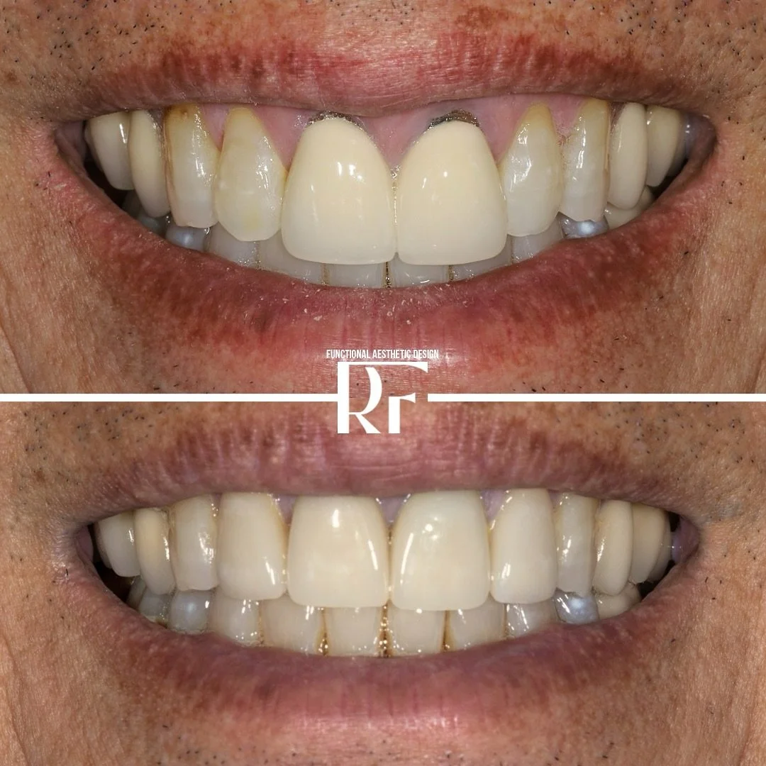 ✨ A Very Special Smile Transformation ✨

This one hits close to home&mdash;because it&rsquo;s my dad.
He&rsquo;s given me so much throughout my life, and it was an honor to give something back: a smile he can feel proud of.

His old crowns were break