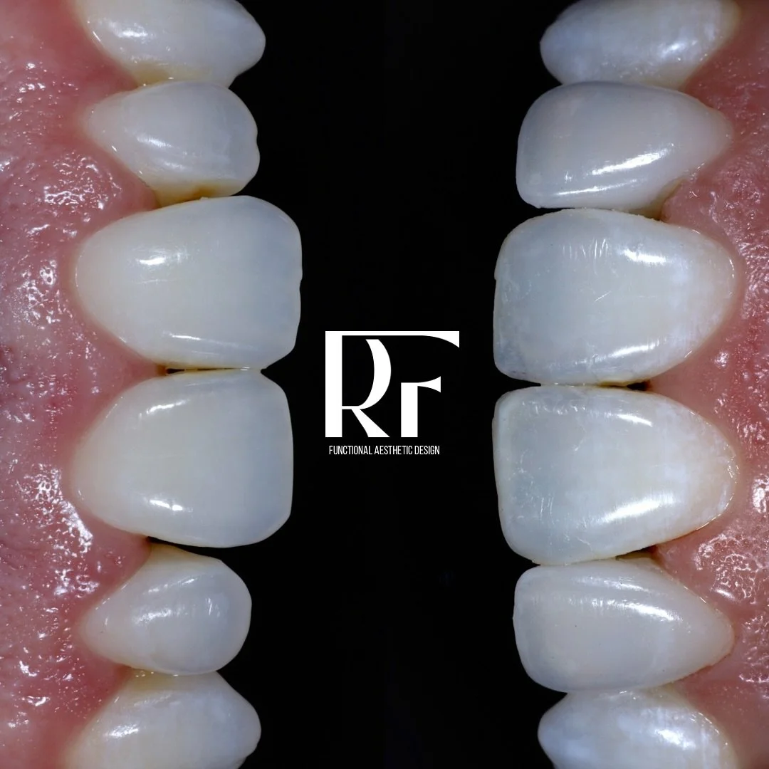 Your smile is more than teeth &mdash; it&rsquo;s confidence, joy, and connection. ✨

When every detail is personalized, the result isn&rsquo;t just a new smile&hellip; it&rsquo;s a new way of showing up in the world.

Ready to love your smile again? 