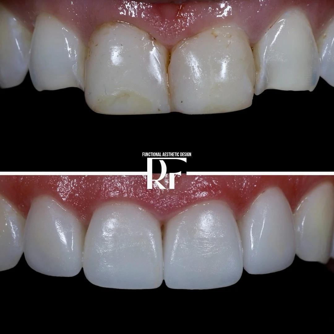 ✨ The Magical Four ✨
When it comes to veneers, sometimes enhancing just the front four teeth can completely transform a smile &mdash; naturally, beautifully, and efficiently. 😍🦷

Whether it&rsquo;s closing spaces, improving shape, or brightening th