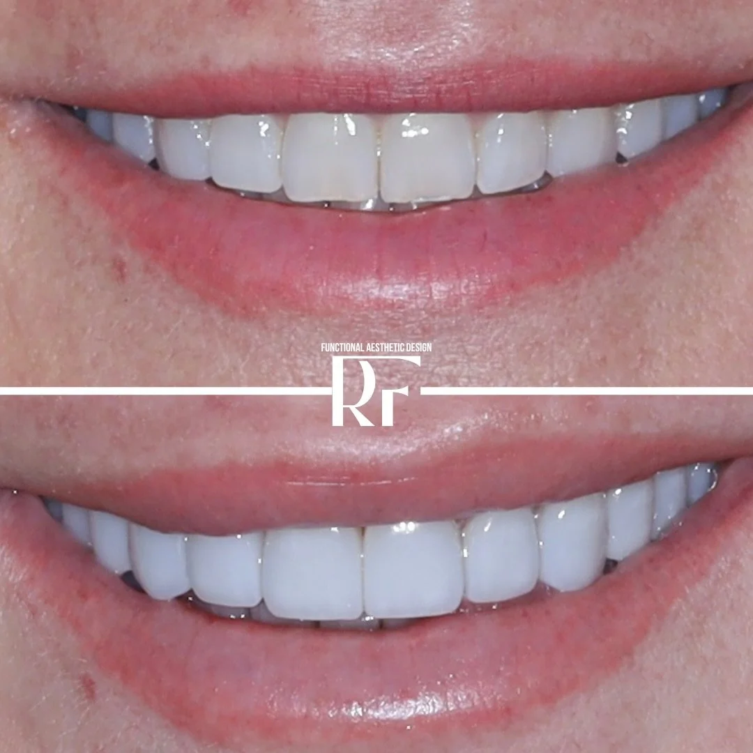 Minimal prep veneers. Maximum confidence.

Small, intentional changes&hellip;
that completely transform how you show up.

It&rsquo;s not about changing who you are.
It&rsquo;s about finally seeing yourself the way you&rsquo;ve always wanted.

That co