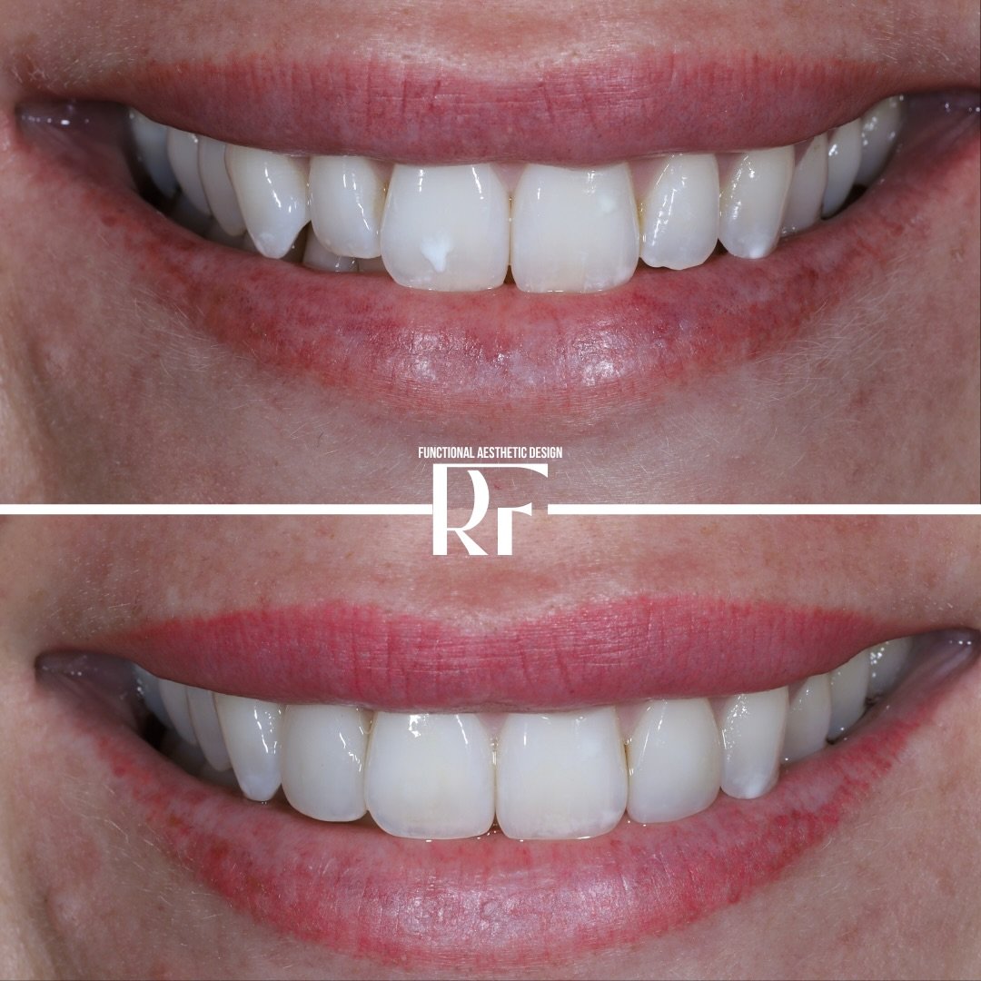Most people think a better smile means veneers.

It doesn&rsquo;t.

It means having someone who actually understands esthetics.

This case wasn&rsquo;t about doing more&hellip; it was about doing the right things, in the right sequence, with intentio