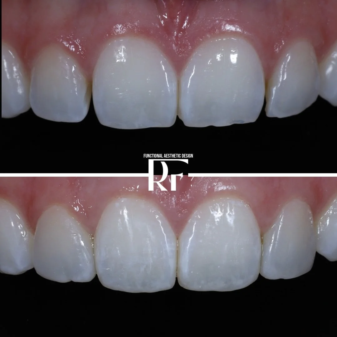 Most people think veneers are about &ldquo;perfect teeth.&rdquo;
They&rsquo;re not. They&rsquo;re about feeling like yourself again when you smile.

This case started with orthodontics to build the foundation&mdash;because if the architecture is off,