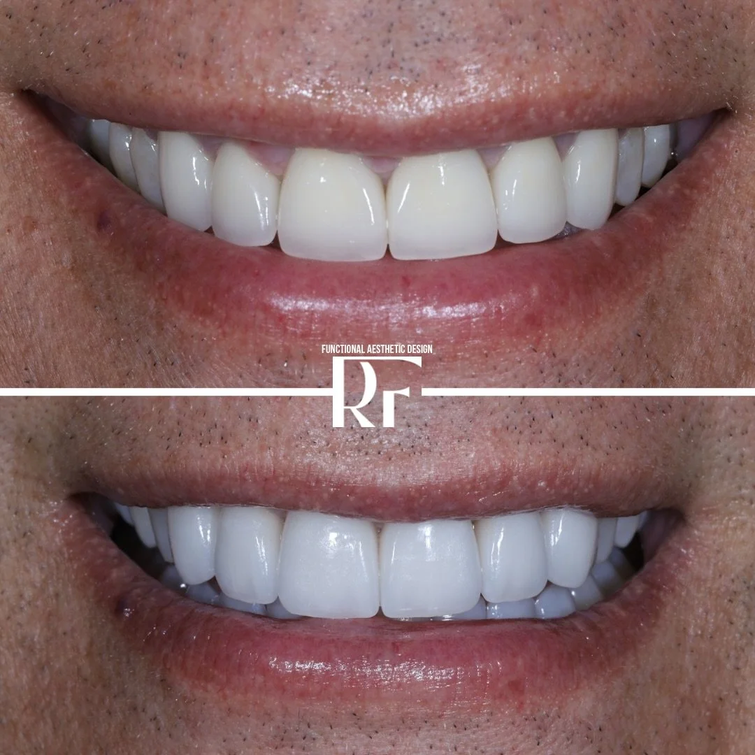 Most people think cosmetic dentistry is about making teeth look better.

I disagree.

This patient wanted a smile upgrade, but the real issue wasn&rsquo;t esthetics&mdash;it was function. Their upper front crowns were hitting the lower teeth incorrec