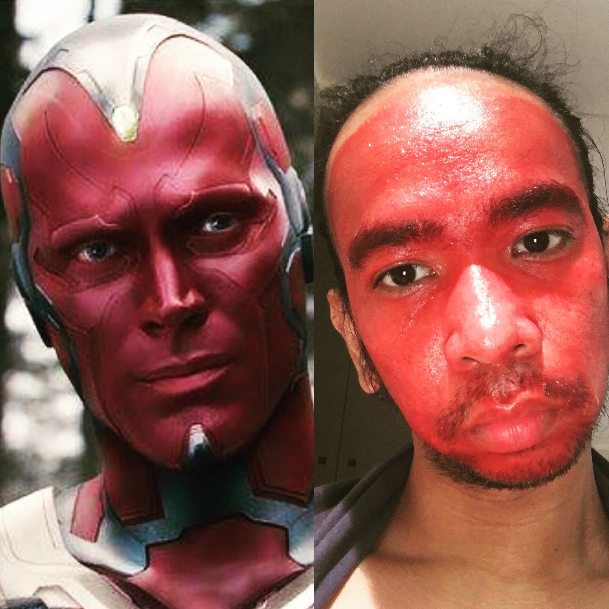 Sunburnt