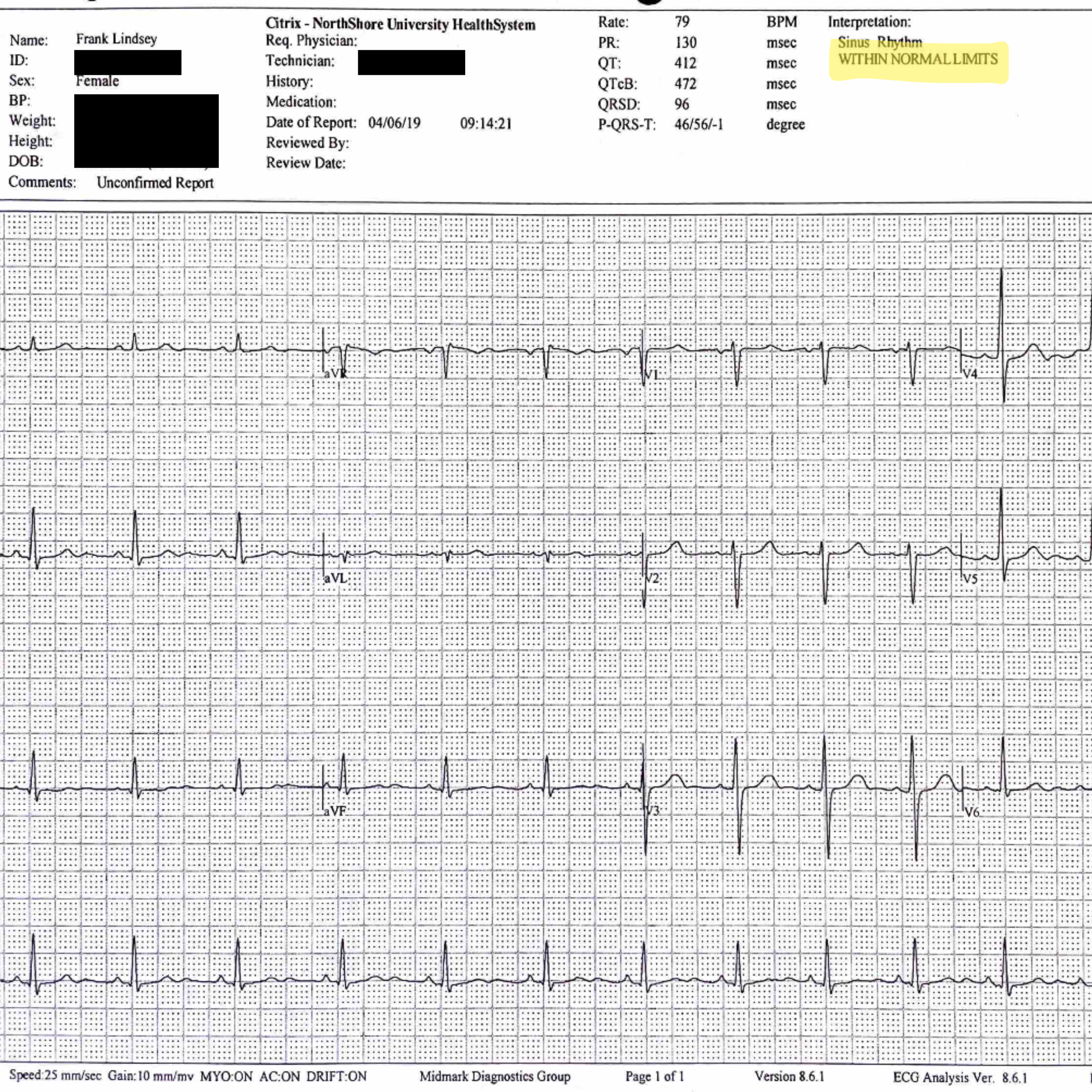 Heart EKG Results "Within Normal Limits"