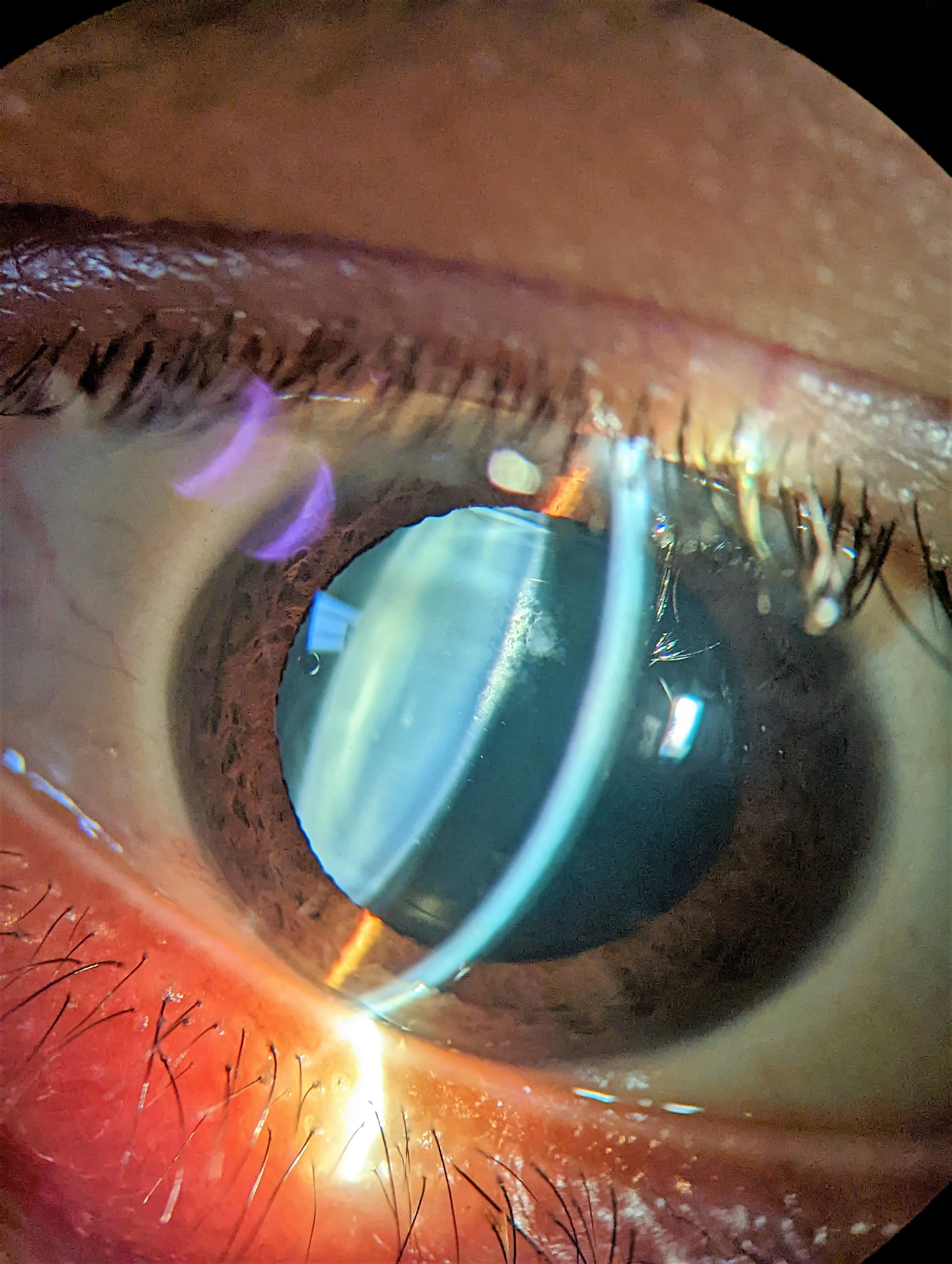 Developing Cataract Jimmy Hu, MD | Ophthalmologist (Eye Doctor) | Cataract, Cornea and ...