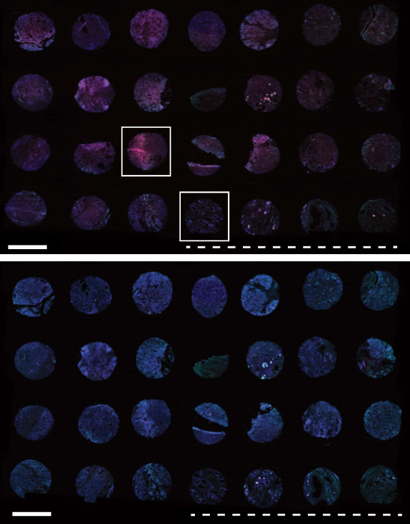 Activatable zymography probes enable in situ localization of protease dysregulation in cancer