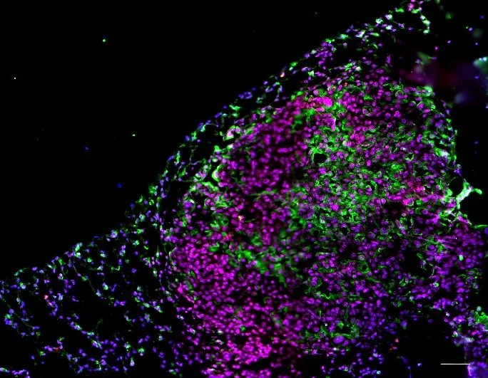 Multimodal profiling of pro-inflammatory protease activity identifies caspase-1 as a target for lung cancer interception