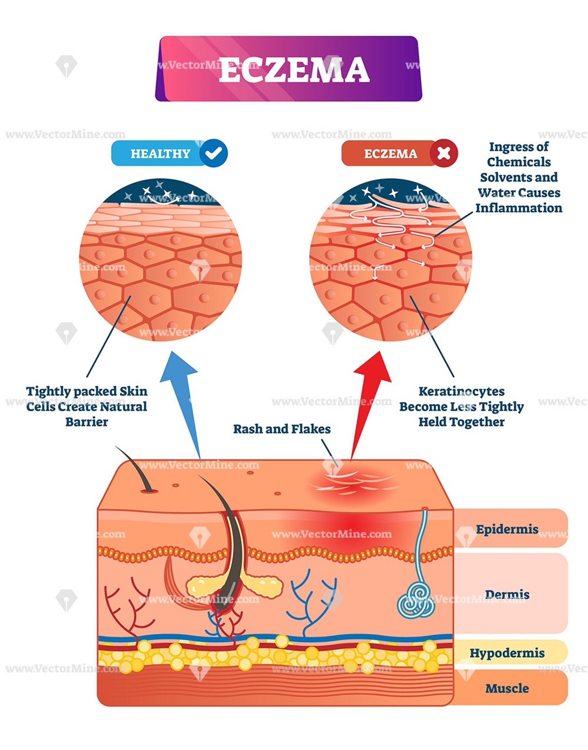 Diagram explaining eczema, showing a comparison between healthy skin and skin affected by eczema. Healthy skin has tightly packed cells creating a natural barrier, while eczema-affected skin has keratinocytes less tightly held together, leading to ra