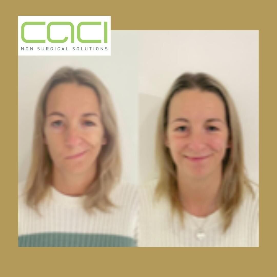 This picture is curtesy of Caci and it fully demonstrates the reason why Caci is one of the most trusted brands in the market. Caci technology came from the  medical research into treating Bells Palsy. Caci is an award winning company with expertise 