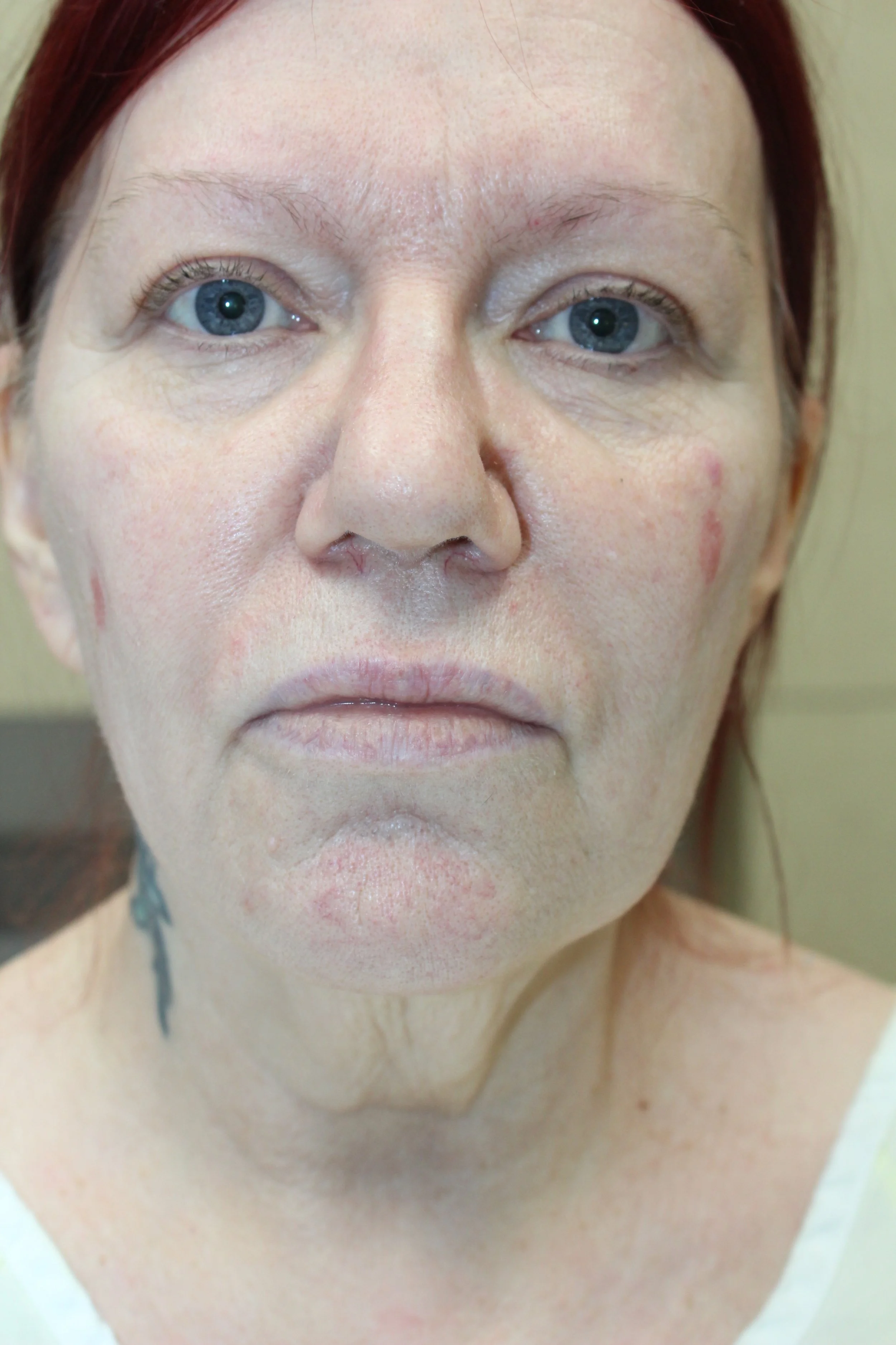 Patient X Preoperative Facelift — Dr Giuffre Plastic Surgeon Edmonton