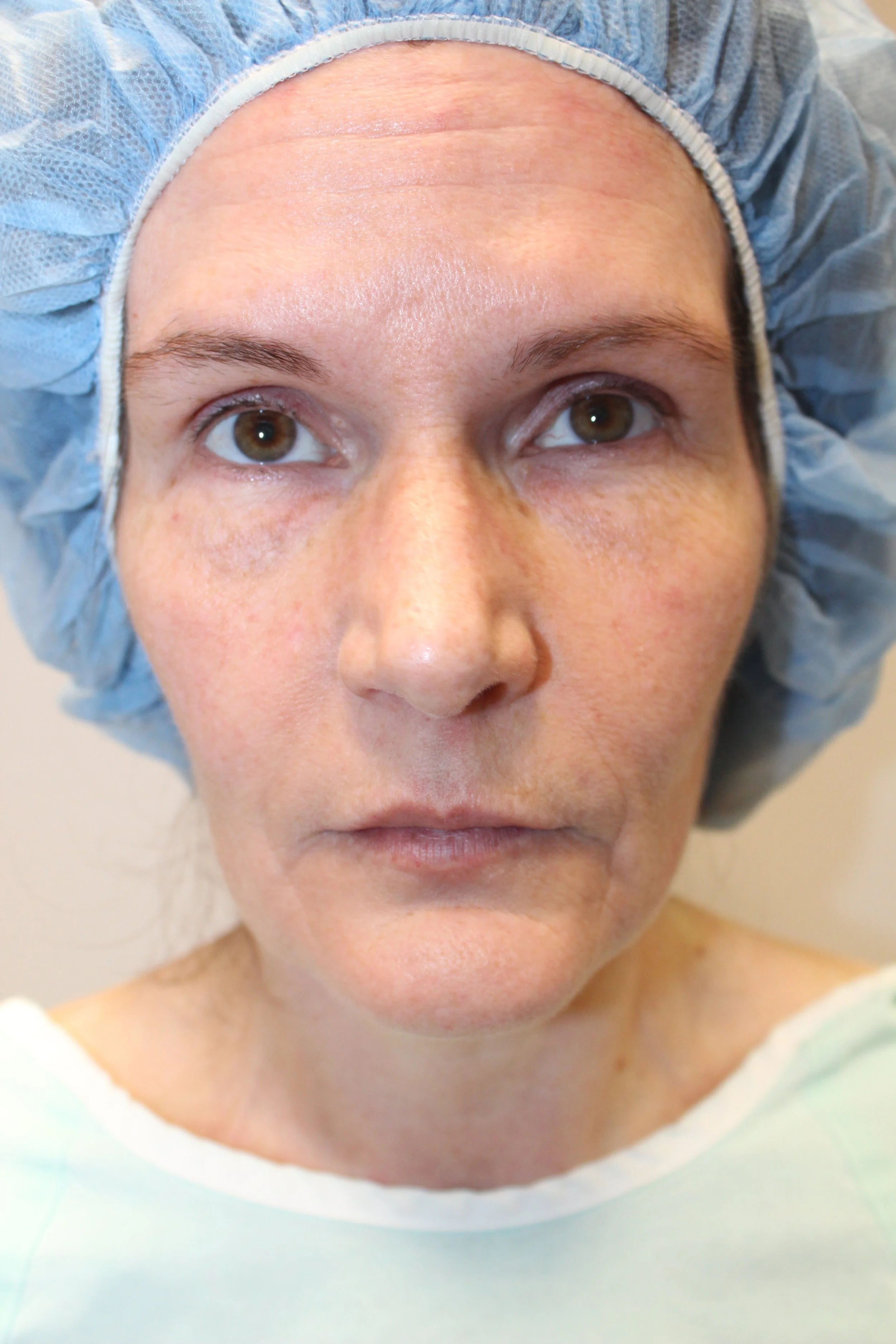 Patient I PreOperative Rhinoplasty — Dr Giuffre Plastic Surgeon Edmonton