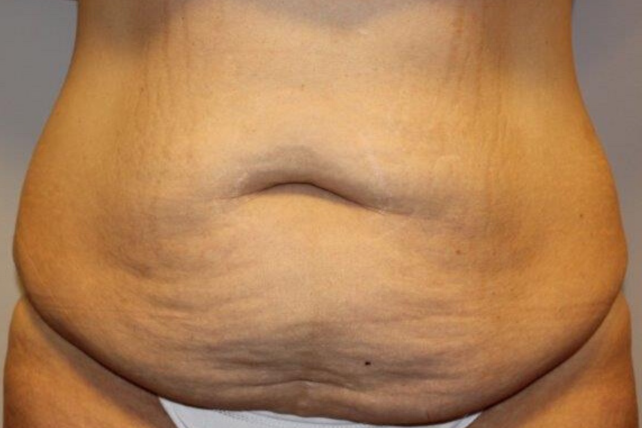 Tummy tuck or lose weight? : r/tummytucksurgery