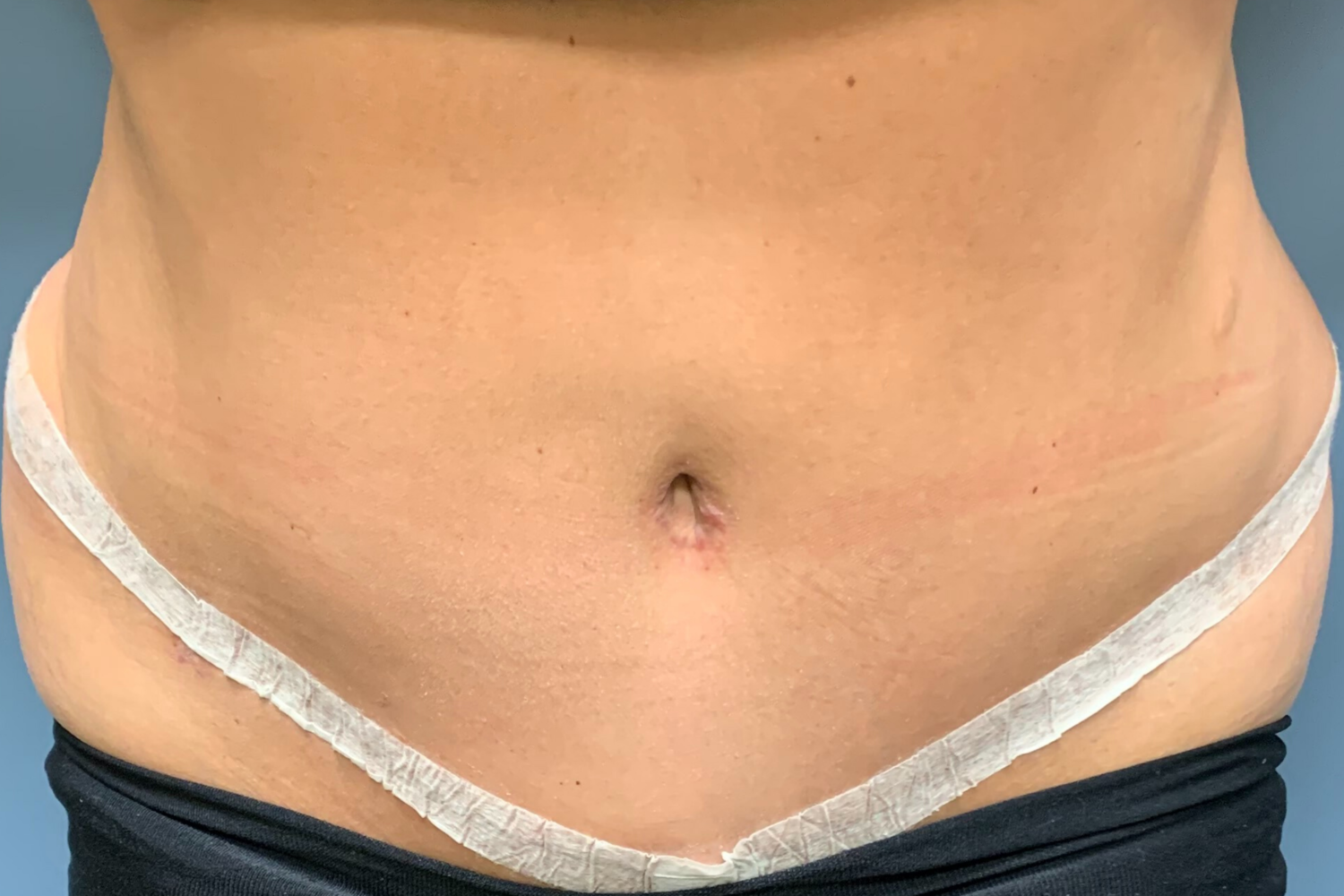 Dr. Giuffre performs Tummy Tuck / Abdominoplasty Surgery in