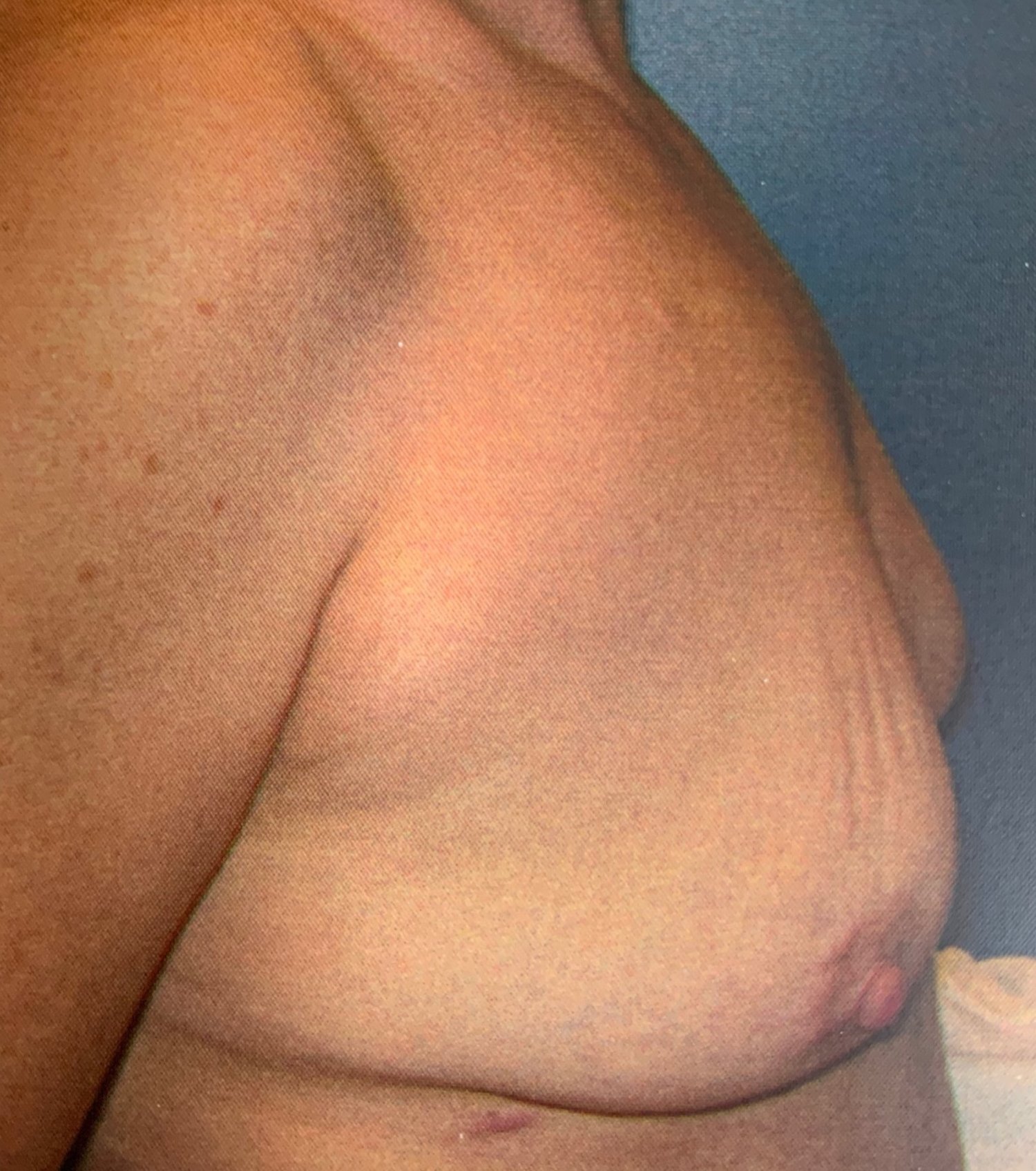 Patient L - Pre-Operative Breast Lift and Breast Augmentation, with a Post-Operative  Tummy Tuck (10 years prior) — Dr Giuffre Plastic Surgeon Edmonton
