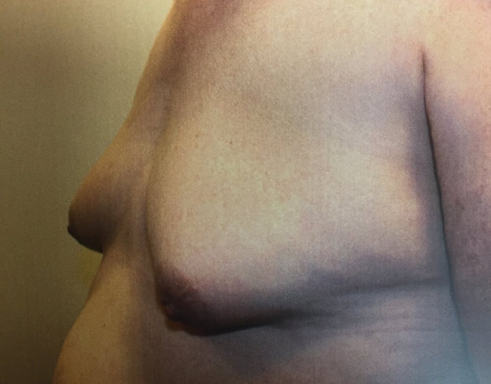 Breast ptosis – PlastSurgeon