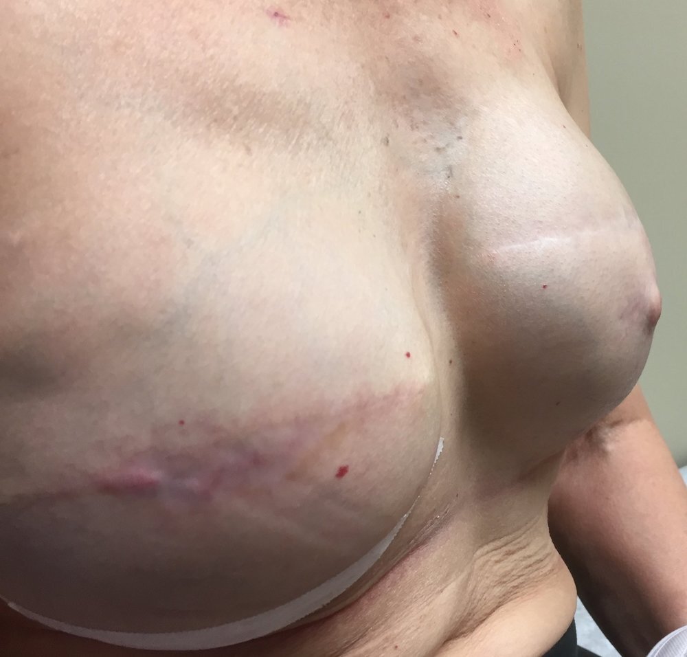Patient F - Bilateral Breast Reconstruction following Breast Cancer — Dr  Giuffre Plastic Surgeon Edmonton