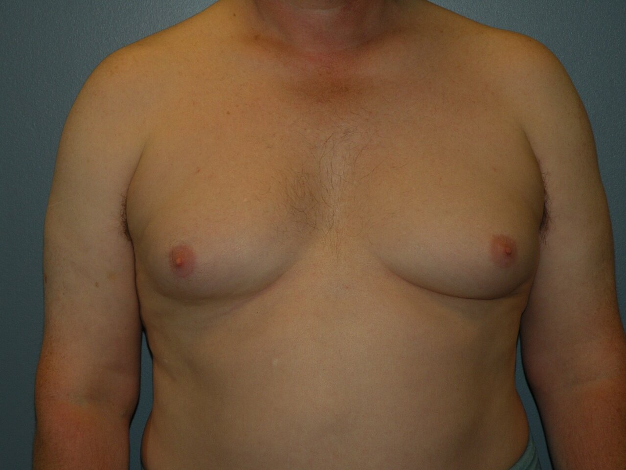 Patient A - Grade IIA Gynecomastia - full female size breast with