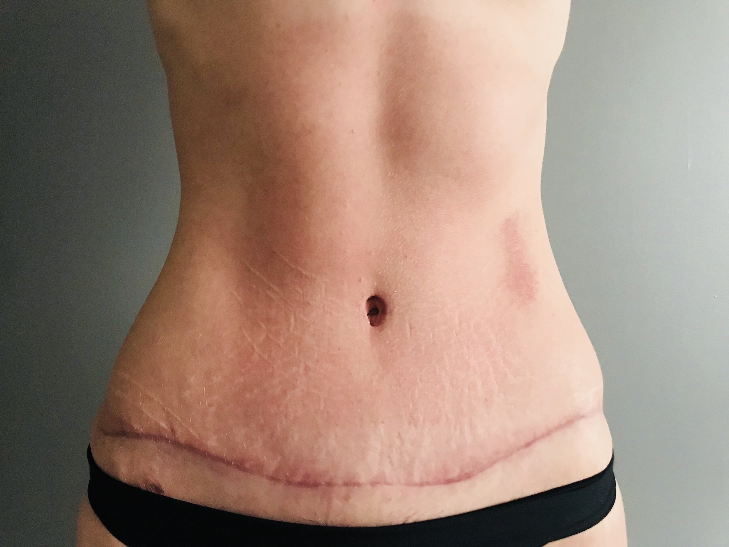 Patient C - 3 months Post-Operative Tummy Tuck Frontal View — Dr Giuffre  Plastic Surgeon Edmonton