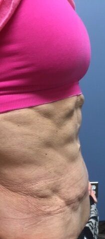 Patient E Body Builder - 6 month Post-Operative Tummy Tuck Lateral