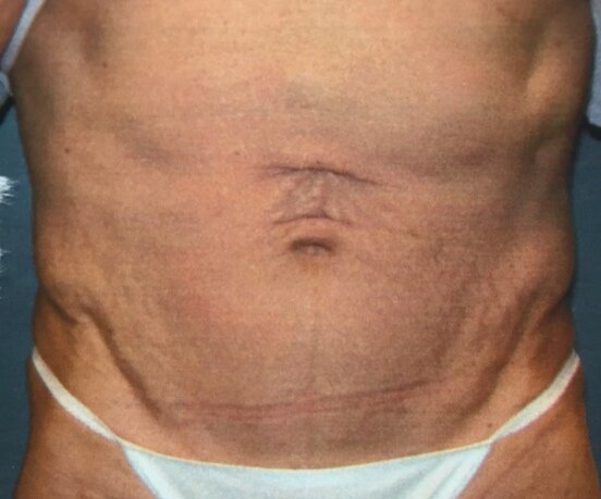 Patient E Body Builder - Pre -Operative Tummy Tuck Frontal Image — Dr  Giuffre Plastic Surgeon Edmonton