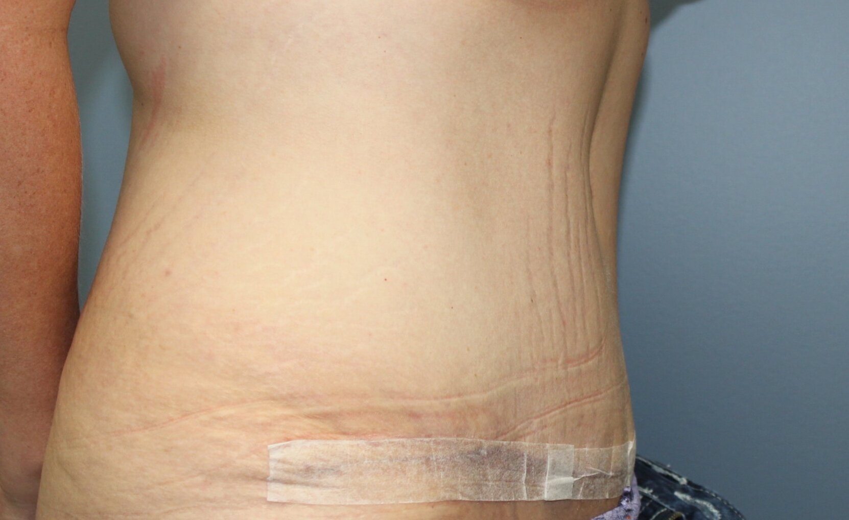 Patient D - Post-Operative Tummy Tuck Lateral Image *Note the improvement  in the upper and lower abdomen with improved contour of the figure. — Dr  Giuffre Plastic Surgeon Edmonton