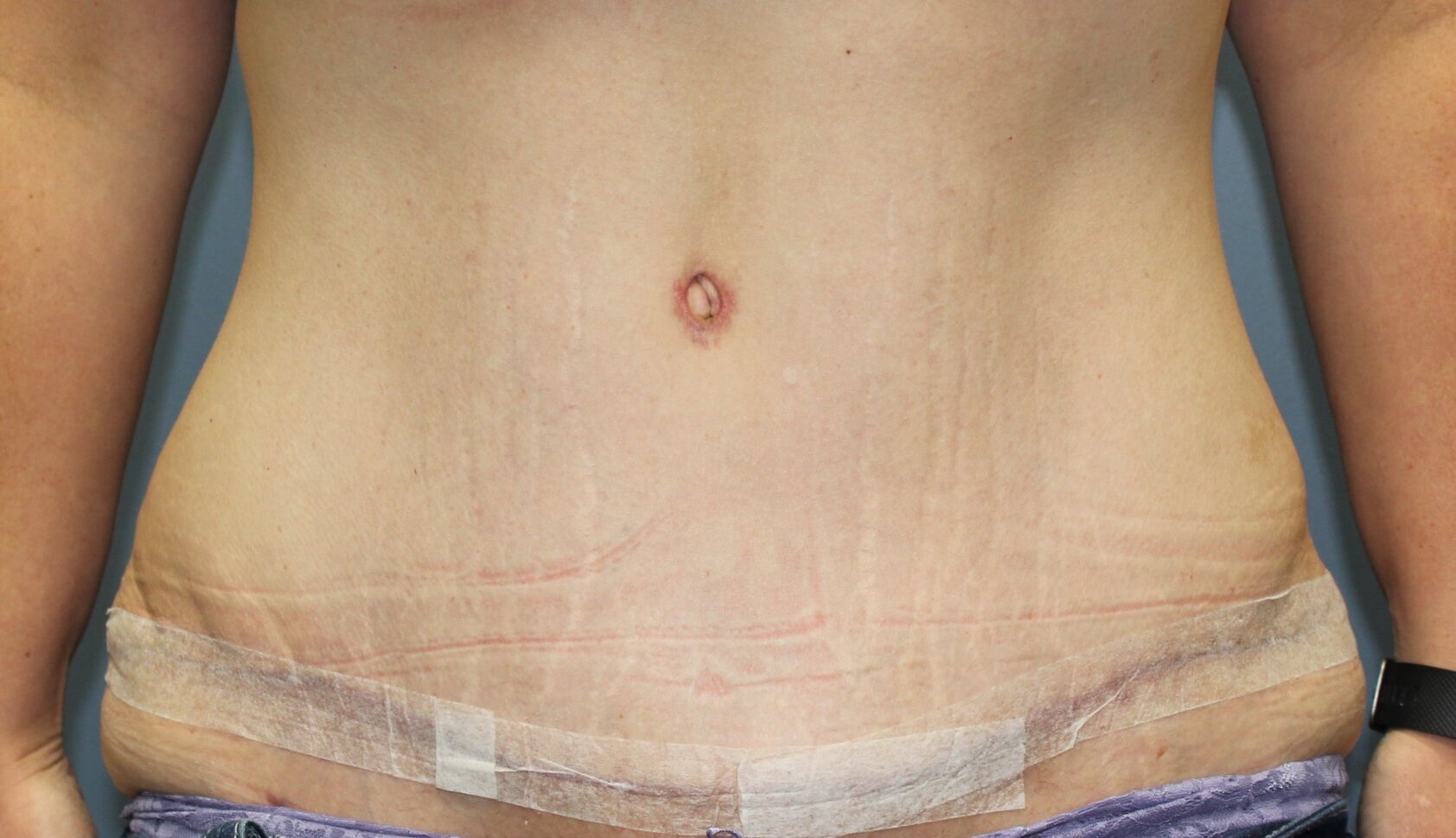 Patient D - Post-Operative Tummy Tuck Frontal Image *Note the