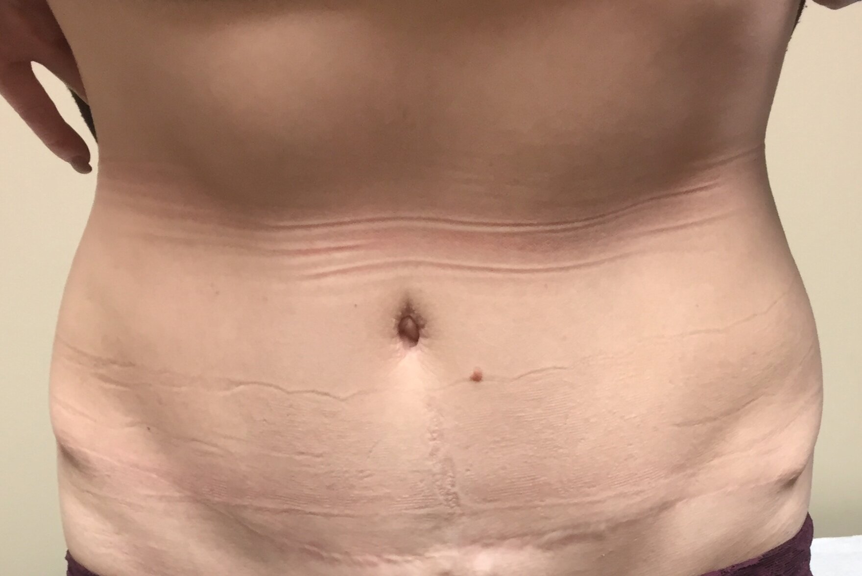 Patient I - 10 Years Post-Operative Tummy Tuck — Dr Giuffre