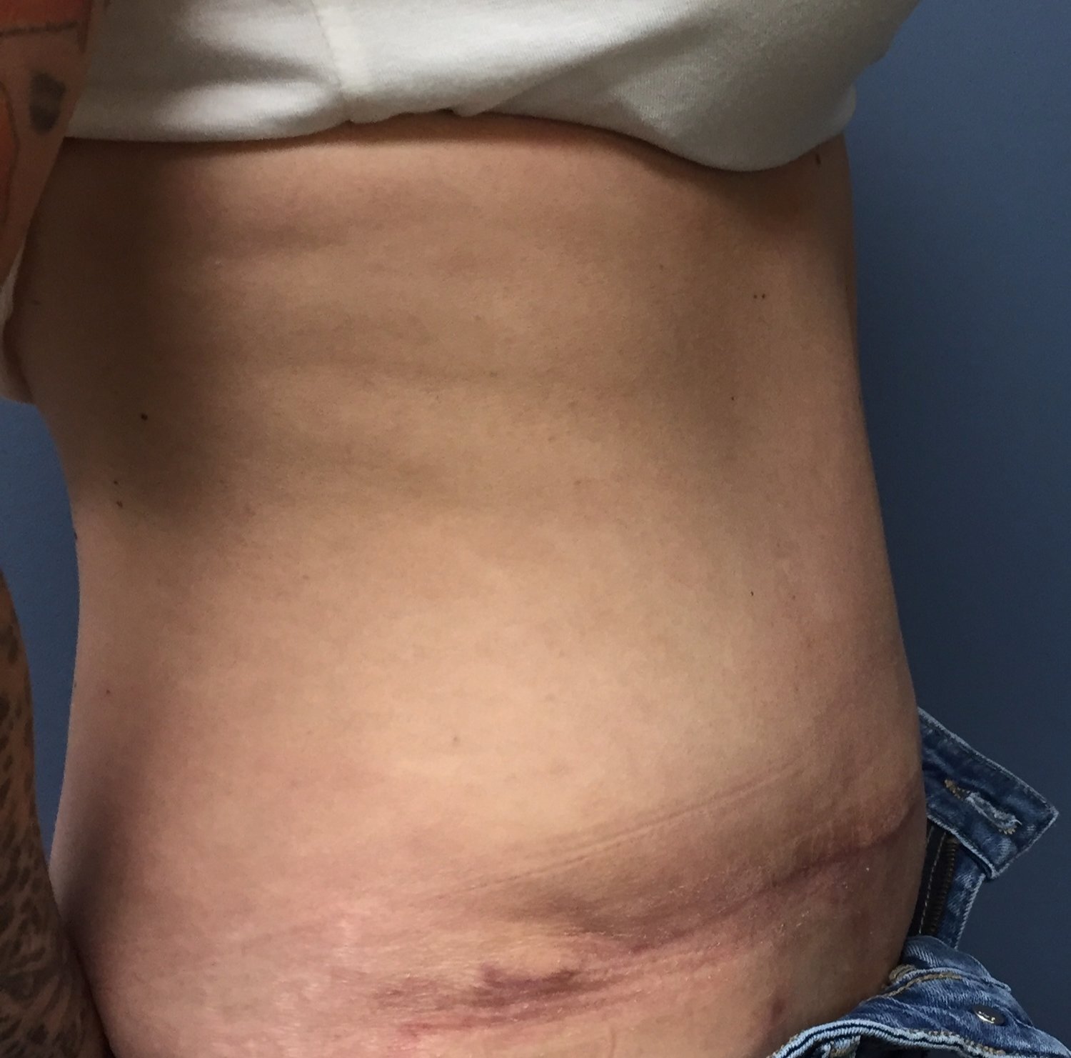 Patient H - 6 weeks Post-Operative Tummy Tuck Lateral Image — Dr