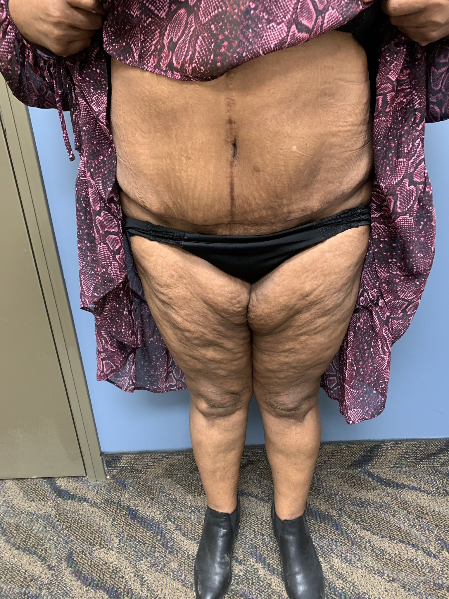 Patient L - Post-operative tummy tuck. Took off 18 pounds. — Dr Giuffre  Plastic Surgeon Edmonton