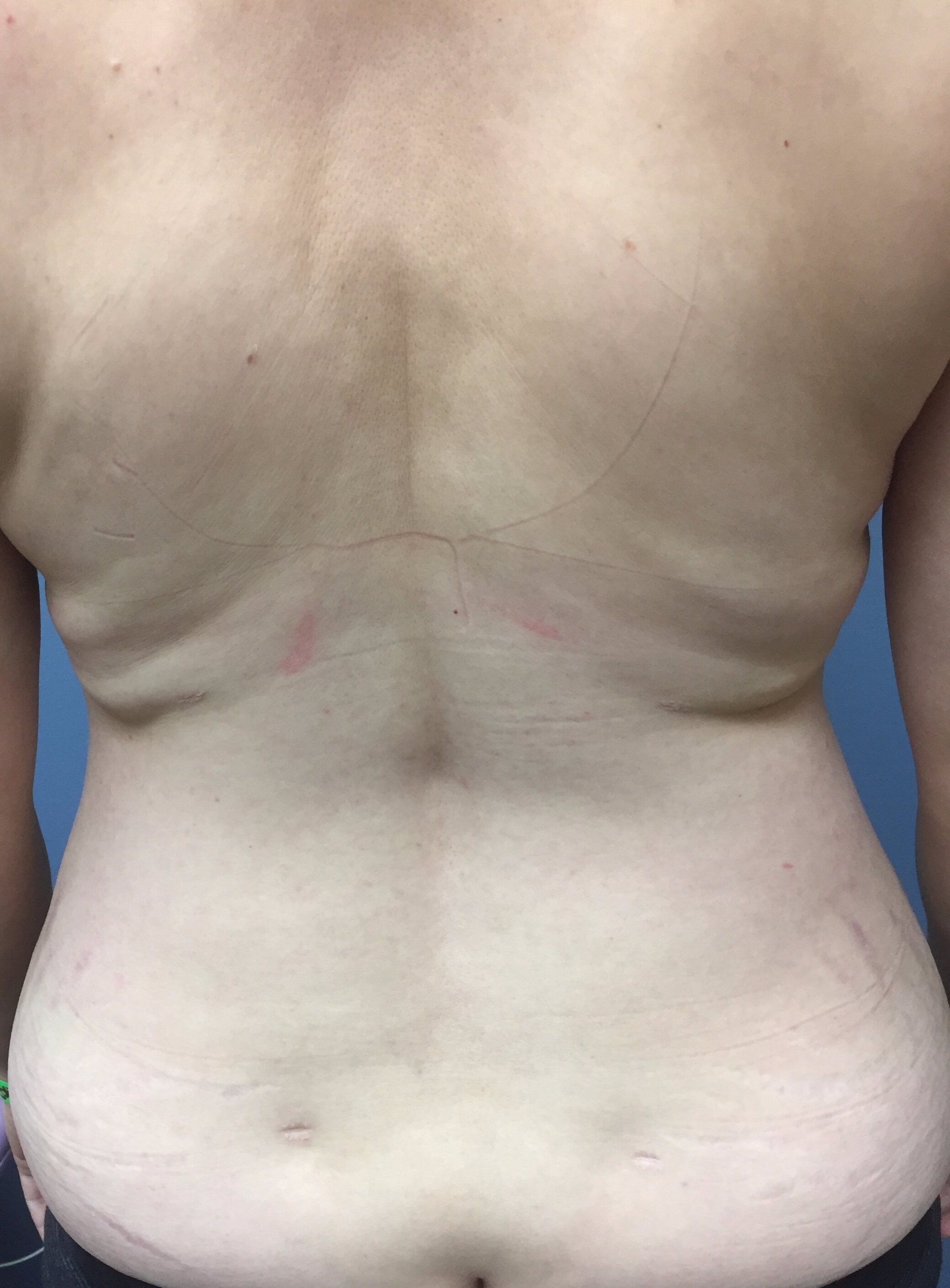 Patient C - Post-Operative Back & Bra line and Hips Liposuction